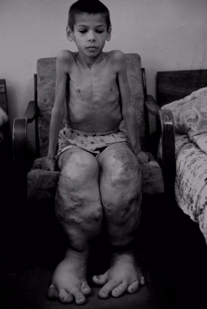 画像 放射能と奇形児 旧ソ連ウクライナのチェルノブイリ原発事故で誕生した負の遺産 象の足 Matomehub まとめハブ