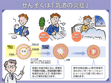 喘息持ちの悲劇　同僚…